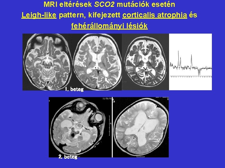 MRI eltérések SCO 2 mutációk esetén Leigh-like pattern, kifejezett corticalis atrophia és fehérállományi lésiók