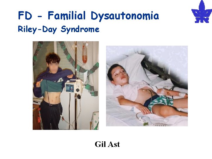 FD - Familial Dysautonomia Riley-Day Syndrome Gil Ast 