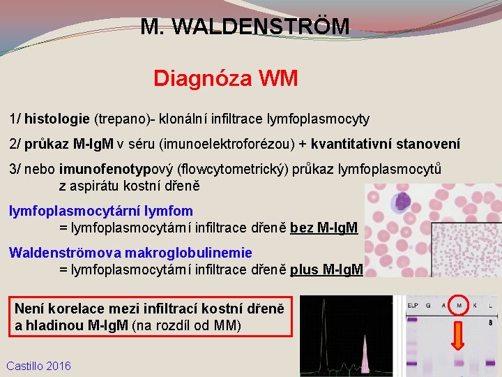 M. WALDENSTRÖM Diagnóza WM 1/ histologie (trepano)- klonální infiltrace lymfoplasmocyty 2/ průkaz M-Ig. M