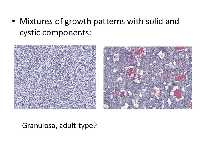  • Mixtures of growth patterns with solid and cystic components: Granulosa, adult-type? 