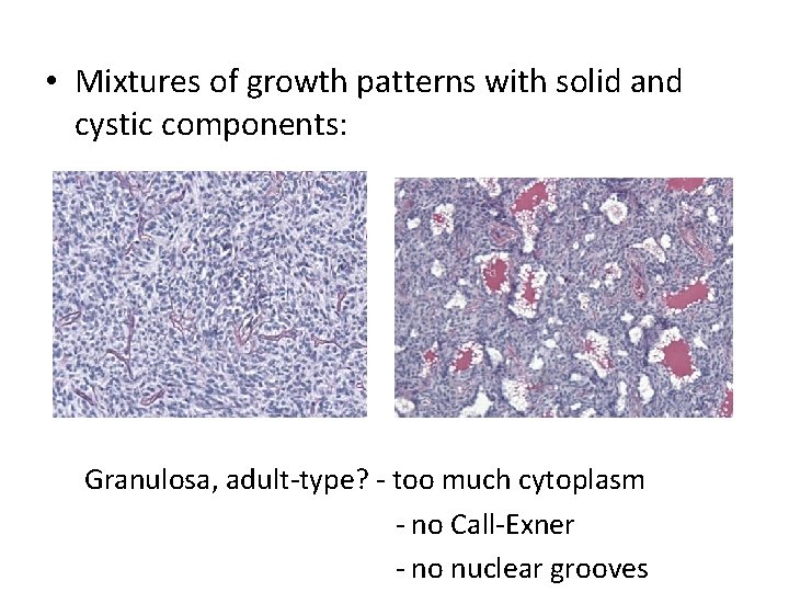  • Mixtures of growth patterns with solid and cystic components: Granulosa, adult-type? -