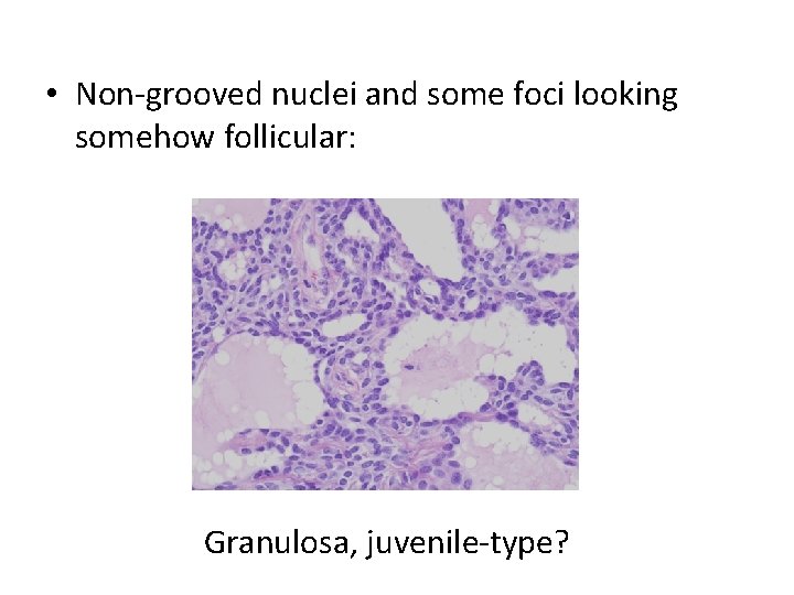  • Non-grooved nuclei and some foci looking somehow follicular: Granulosa, juvenile-type? 