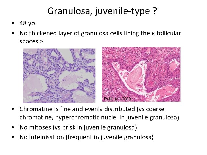 Granulosa, juvenile-type ? • 48 yo • No thickened layer of granulosa cells lining