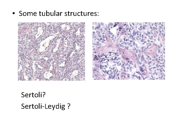  • Some tubular structures: Sertoli? Sertoli-Leydig ? 