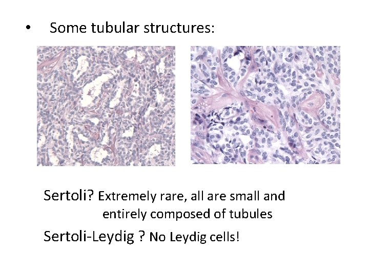  • Some tubular structures: Sertoli? Extremely rare, all are small and entirely composed