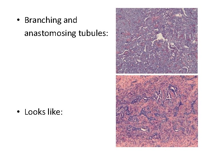  • Branching and anastomosing tubules: • Looks like: 