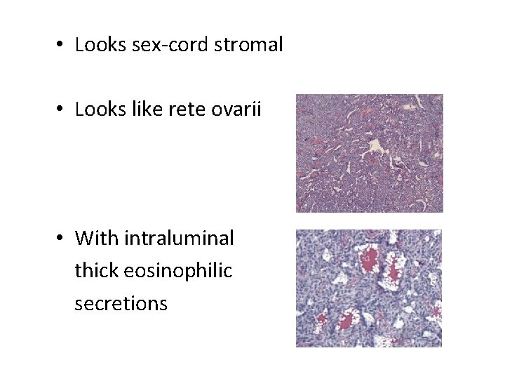  • Looks sex-cord stromal • Looks like rete ovarii • With intraluminal thick