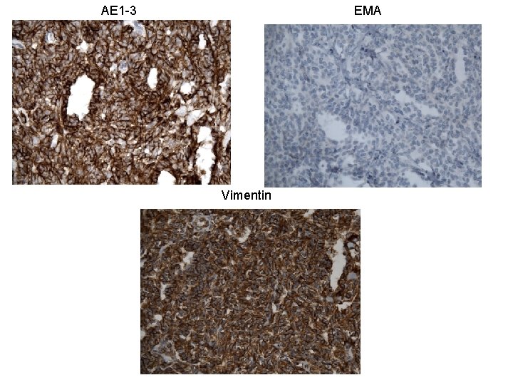 AE 1 -3 EMA Vimentin 