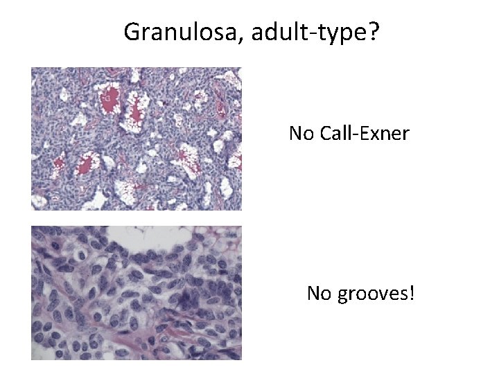 Granulosa, adult-type? No Call-Exner No grooves! 
