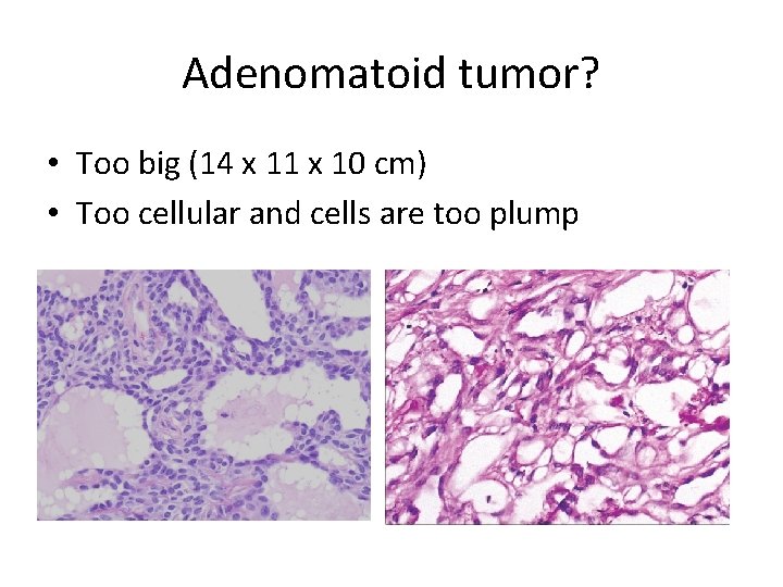 Adenomatoid tumor? • Too big (14 x 11 x 10 cm) • Too cellular