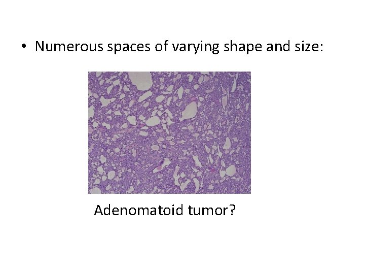  • Numerous spaces of varying shape and size: Adenomatoid tumor? 