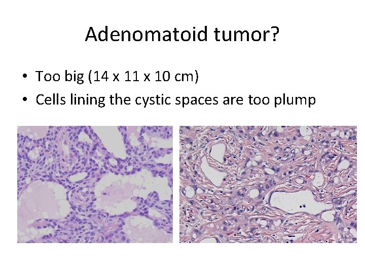 Adenomatoid tumor? • Too big (14 x 11 x 10 cm) • Cells lining