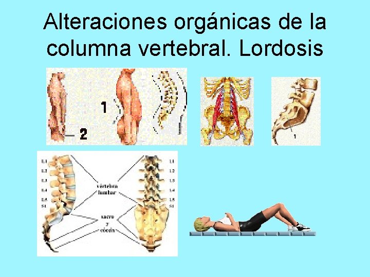 Alteraciones orgánicas de la columna vertebral. Lordosis 