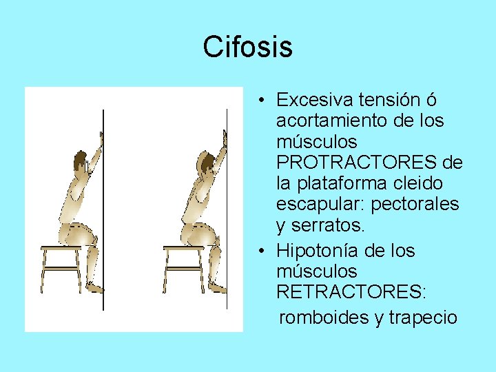 Cifosis • Excesiva tensión ó acortamiento de los músculos PROTRACTORES de la plataforma cleido