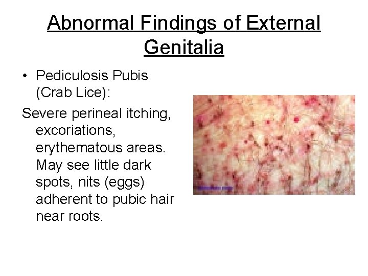 Abnormal Findings of External Genitalia • Pediculosis Pubis (Crab Lice): Severe perineal itching, excoriations,