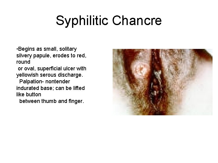 Syphilitic Chancre • Begins as small, solitary silvery papule, erodes to red, round or