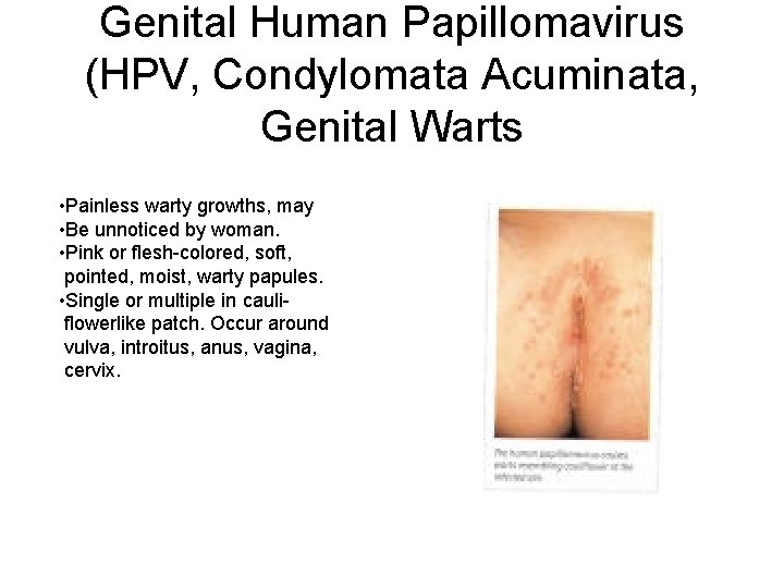 Genital Human Papillomavirus (HPV, Condylomata Acuminata, Genital Warts • Painless warty growths, may •