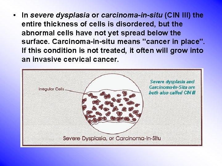  • In severe dysplasia or carcinoma-in-situ (CIN III) the entire thickness of cells
