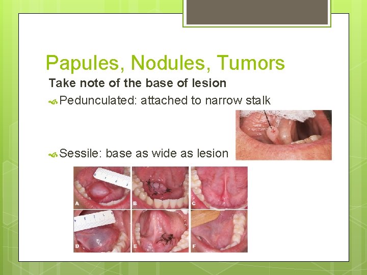 Papules, Nodules, Tumors Take note of the base of lesion Pedunculated: attached to narrow