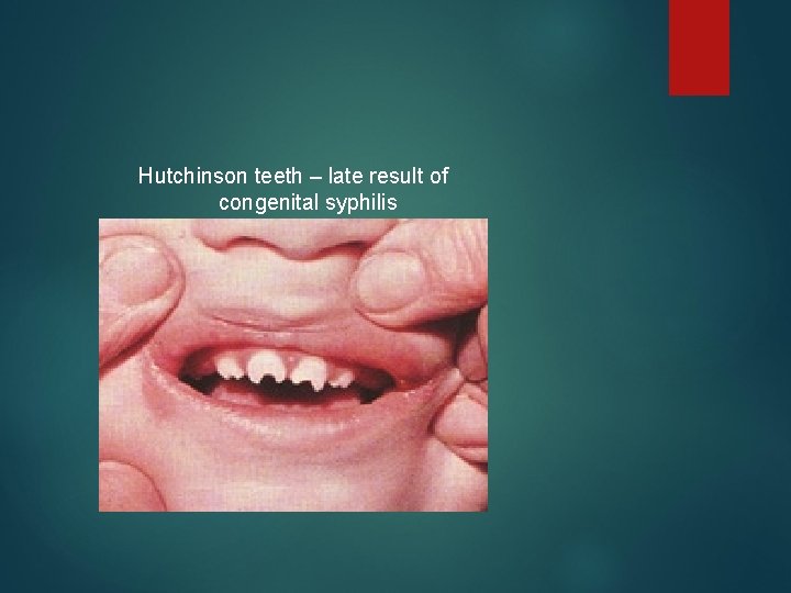 Hutchinson teeth – late result of congenital syphilis 