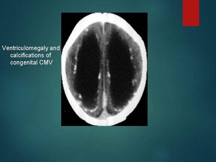 Ventriculomegaly and calcifications of congenital CMV 