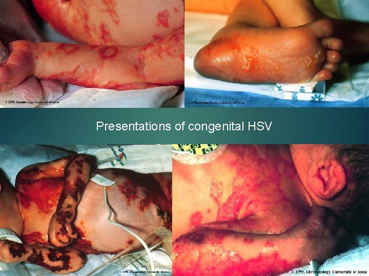 Presentations of congenital HSV 