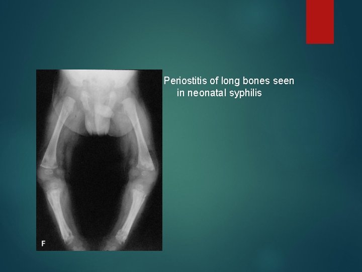 Periostitis of long bones seen in neonatal syphilis 