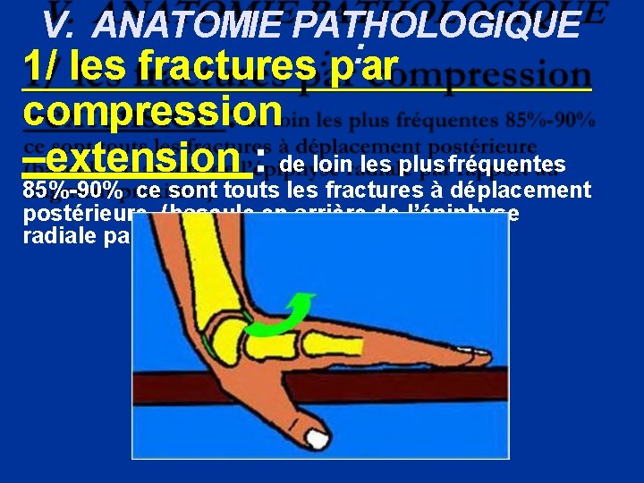 V. ANATOMIE PATHOLOGIQUE : 1/ les fractures p ar compression –extension : de loin