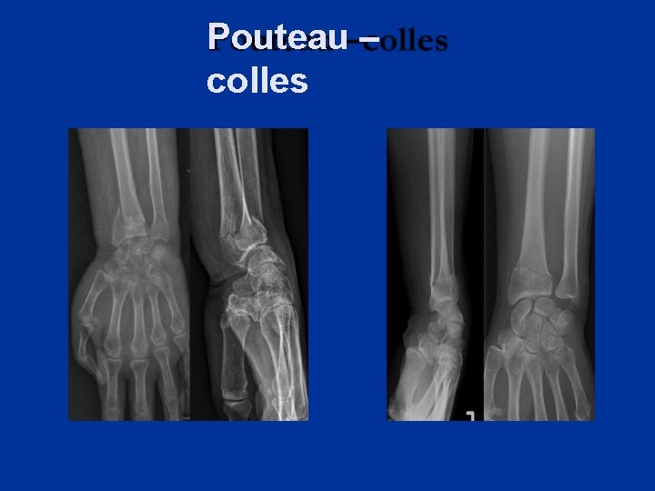Pouteau – colles 