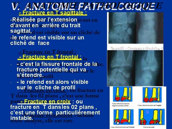V. - Fracture ANATOMIE PATHOLOGIQUE en T sagittale : -Réalisée par l’extension d’avant en