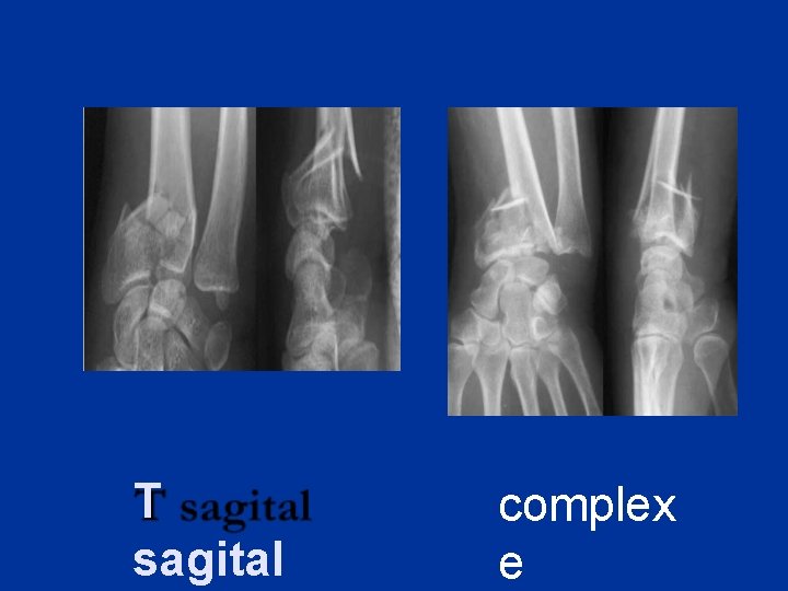 T sagital complex e 