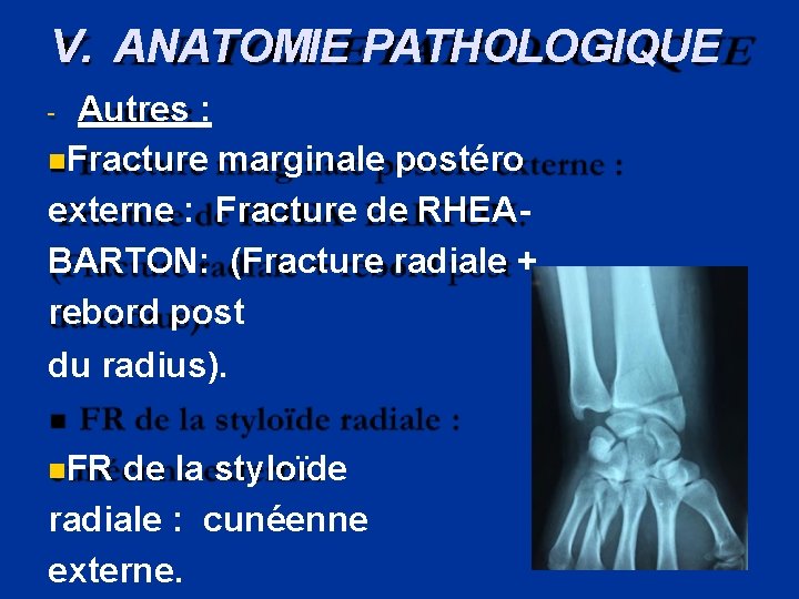 V. ANATOMIE PATHOLOGIQUE Autres : Fracture marginale postéro externe : Fracture de RHEABARTON: (Fracture