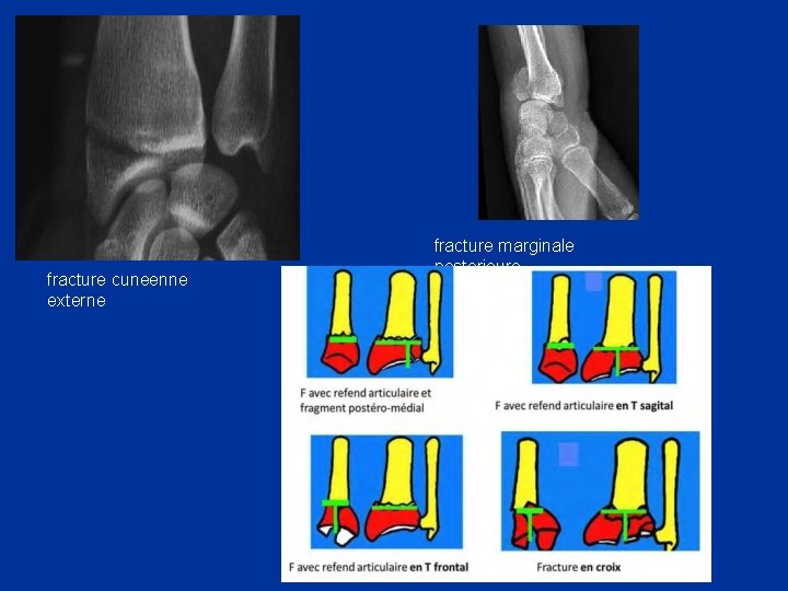 fracture cuneenne externe fracture marginale posterieure 
