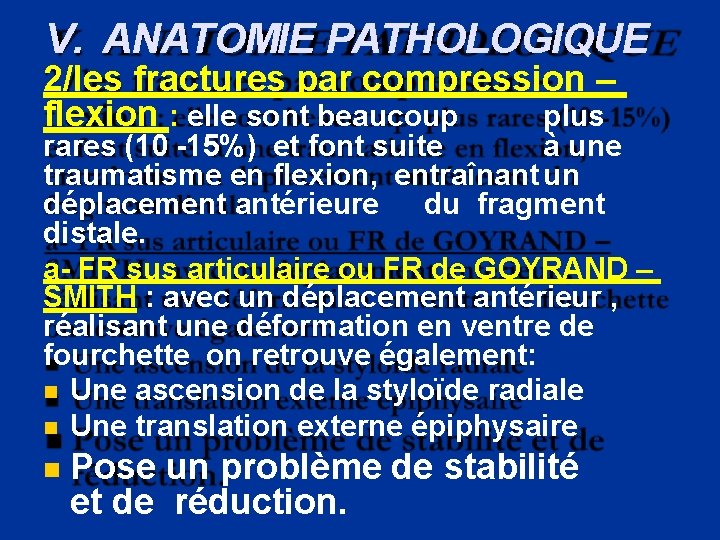 V. ANATOMIE PATHOLOGIQUE 2/les fractures par compression – flexion : elle sont beaucoup plus