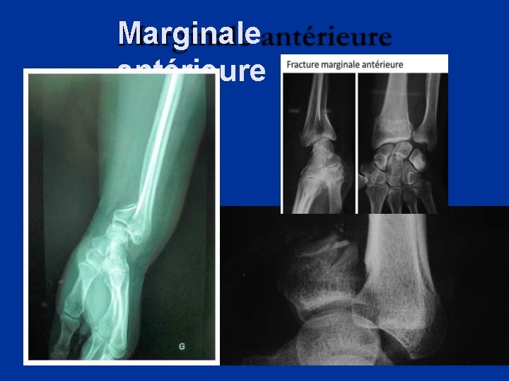 Marginale antérieure 