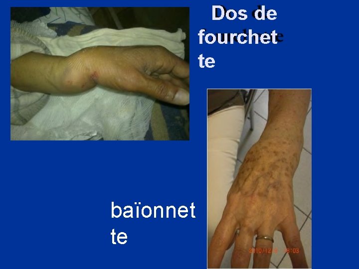 Dos de fourchet te baïonnet te 