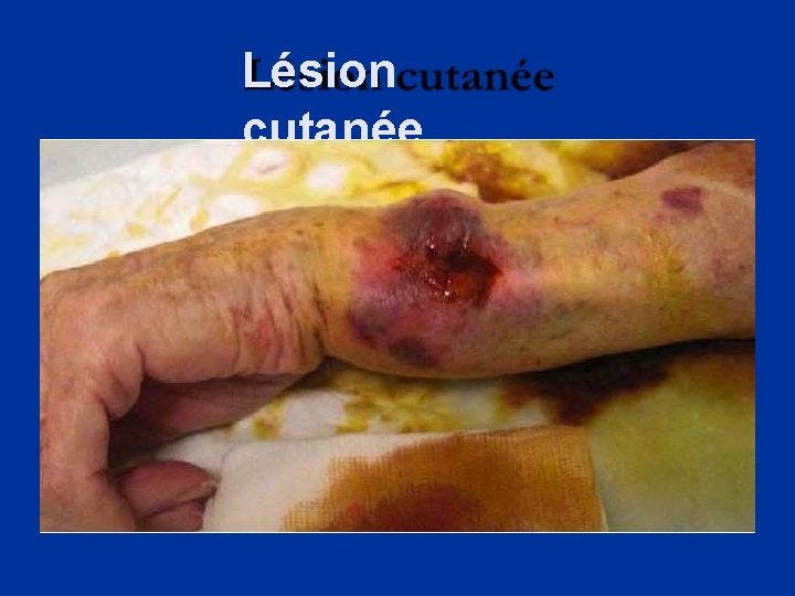 Lésion cutanée 