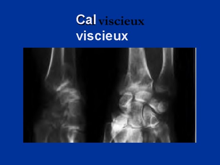 Cal viscieux 