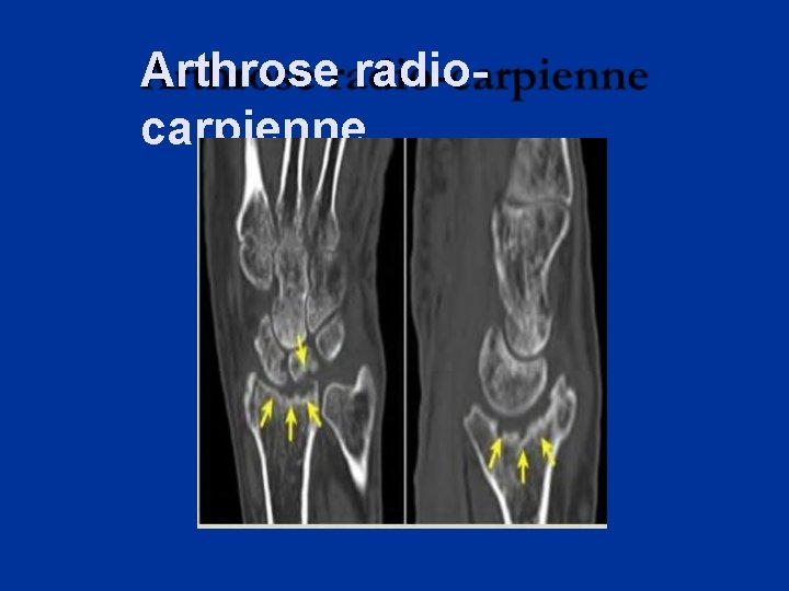 Arthrose radiocarpienne 