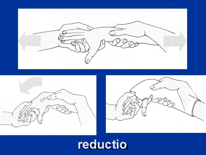 reductio 