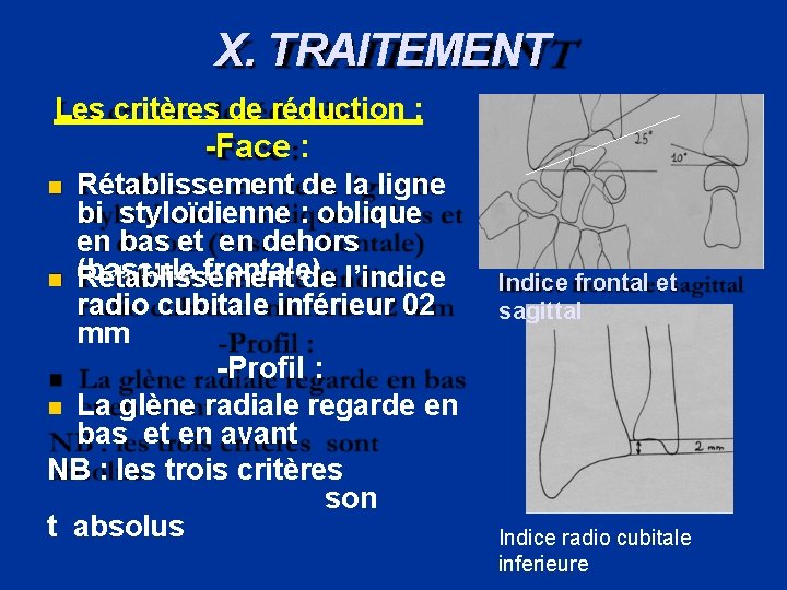 X. TRAITEMENT Les critères de réduction : -Face : Rétablissement de la ligne bi