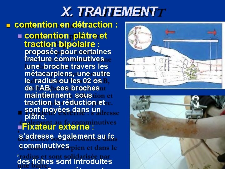 X. TRAITEMENT contention en détraction : contention plâtre et traction bipolaire : proposée pour