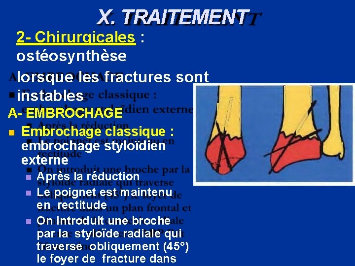 X. TRAITEMENT 2 - Chirurgicales : ostéosynthèse lorsque les fractures sont instables A- EMBROCHAGE