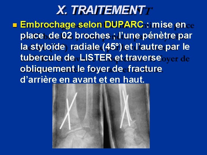 X. TRAITEMENT Embrochage selon DUPARC : mise en place de 02 broches ; l’une