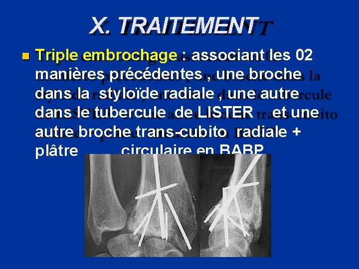 X. TRAITEMENT Triple embrochage : associant les 02 manières précédentes , une broche dans