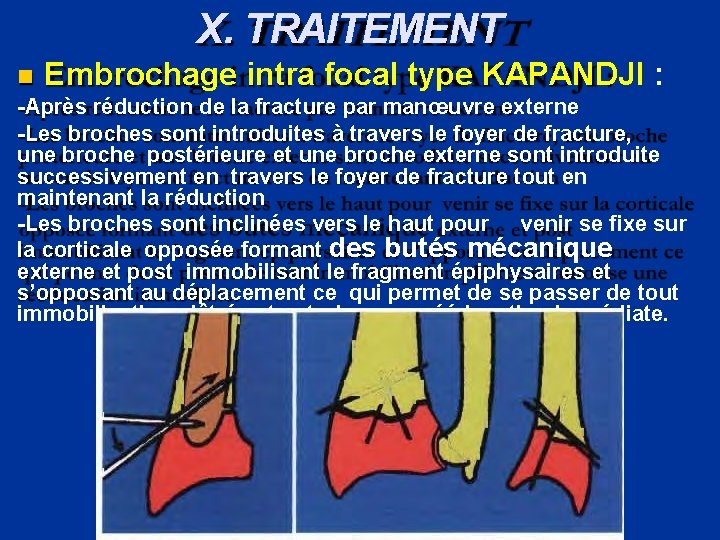 X. TRAITEMENT Embrochage intra focal type KAPANDJI : -Après réduction de la fracture par