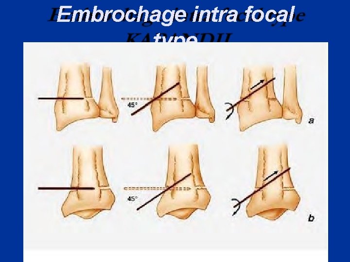 Embrochage intra focal type KAPANDJI 