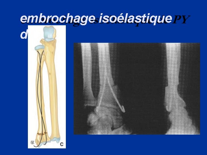 embrochage isoélastique de PY 