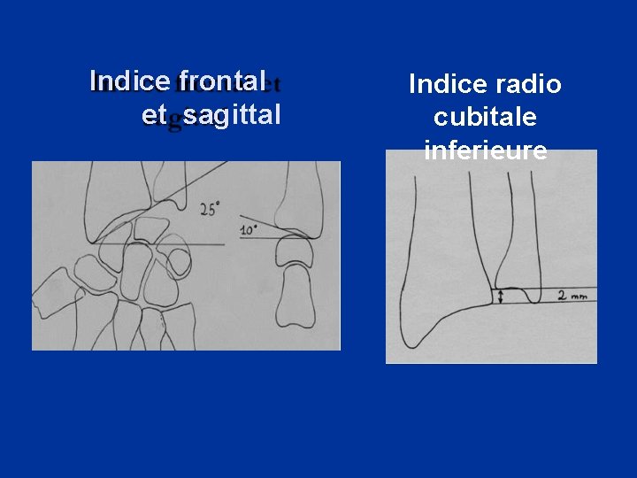 Indice frontal et sagittal Indice radio cubitale inferieure 