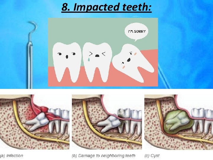 8. Impacted teeth: 